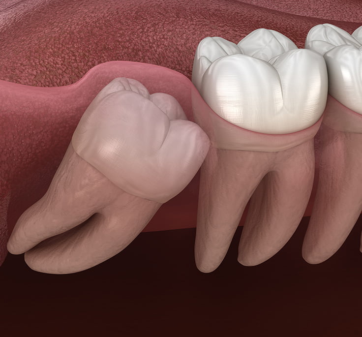 wisdom teeth image