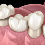 cerec same-day crowns. same-day crowns, dentist in mabank