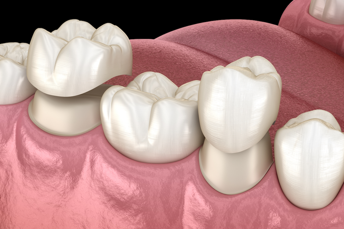 cerec same-day crowns. same-day crowns, dentist in mabank