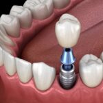 dentures, dental implants, dentures vs implants, implant-supported dentures, tooth replacement, Magnolia Dental