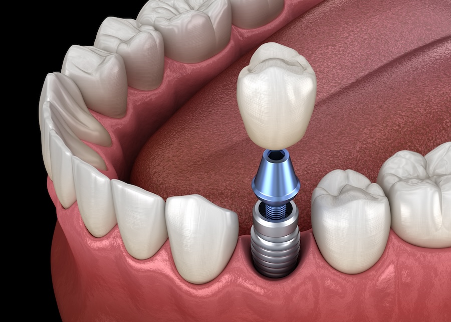 dentures, dental implants, dentures vs implants, implant-supported dentures, tooth replacement, Magnolia Dental