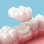 same-day dental crowns, dentist in Mabank, TX, CEREC technology, dental crowns