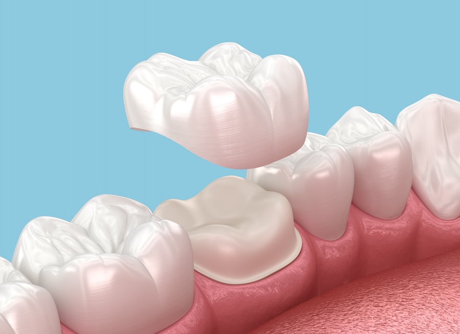 same-day dental crowns, dentist in Mabank, TX, CEREC technology, dental crowns