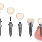 parts of a dental implant for dental implant care