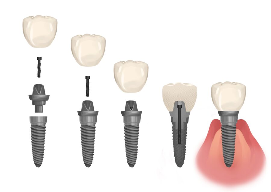 parts of a dental implant for dental implant care