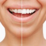 woman with dental veneers instead of teeth whitening