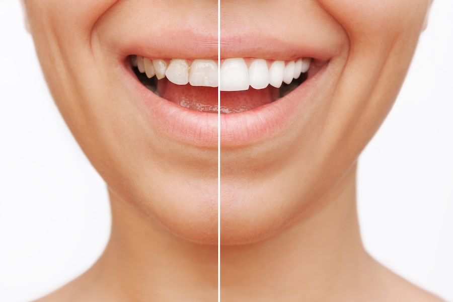 woman with dental veneers instead of teeth whitening