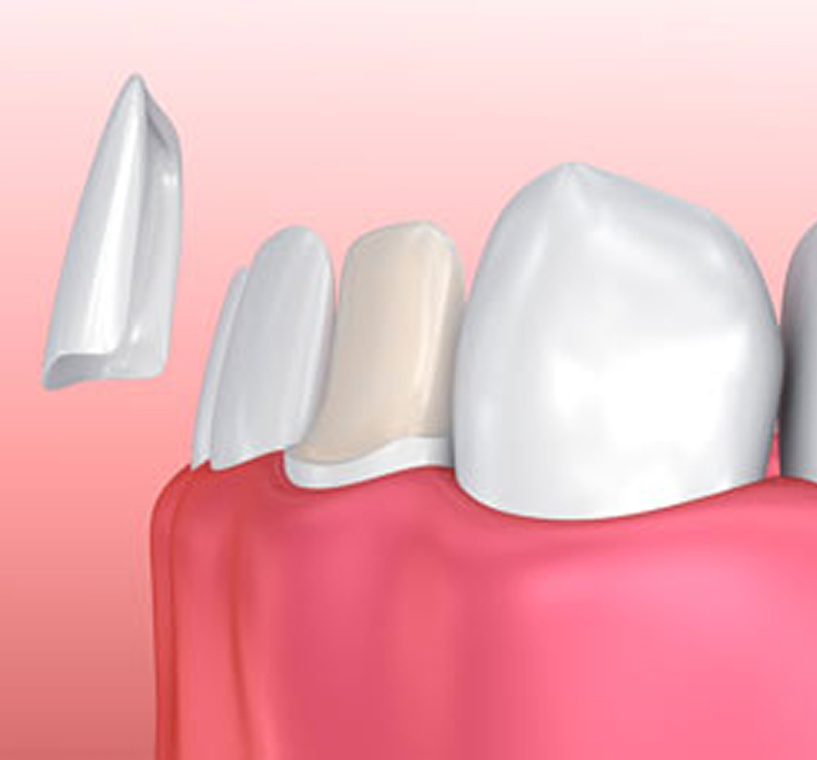 illustration of veneers