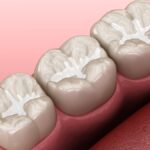dental sealants for cavity prevention