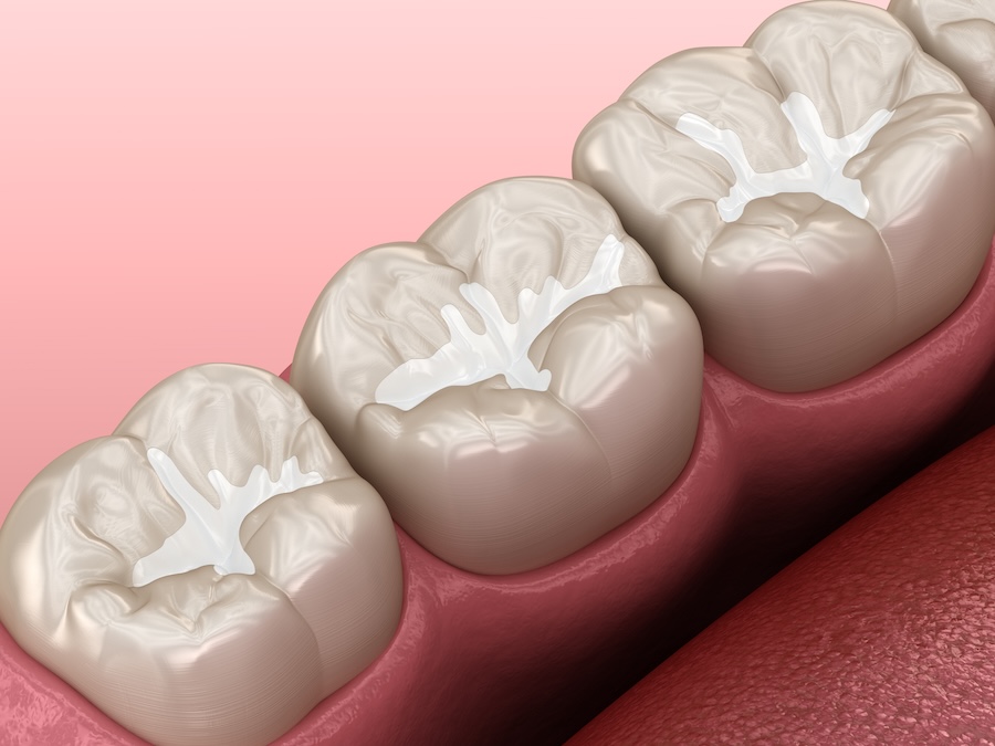 dental sealants for cavity prevention