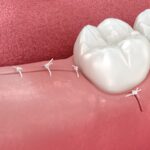 wisdom tooth removal