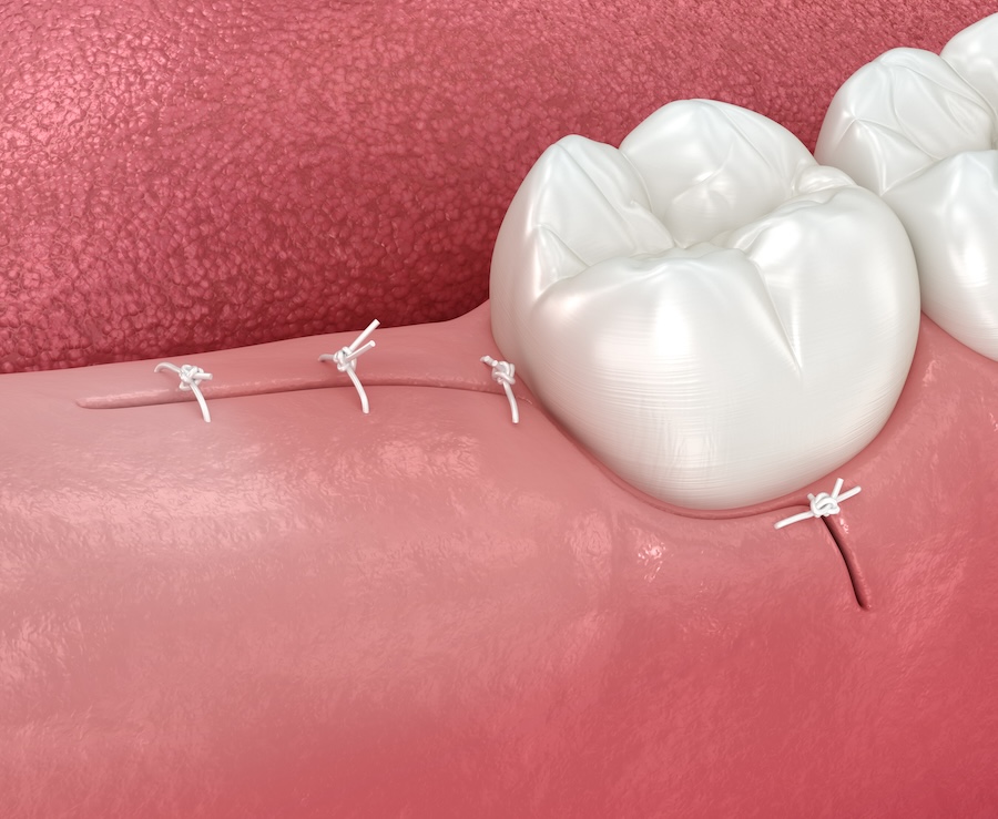 wisdom tooth removal